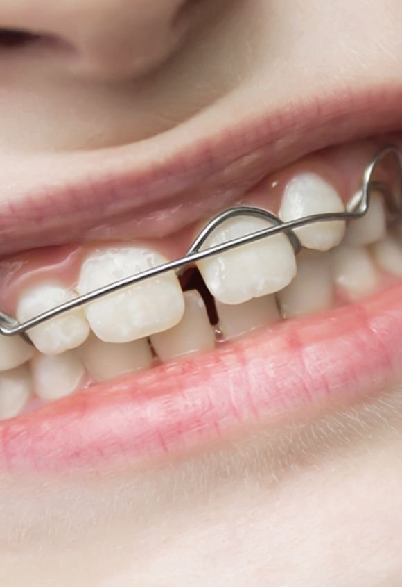 Ortodoncia infantil en Raga Manresa