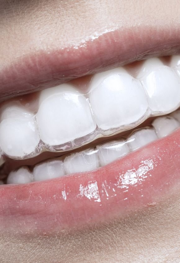 Ortodoncia invisible en Raga Manresa