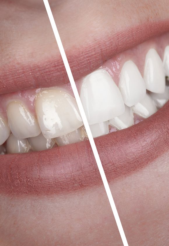 blanqueamiento-dental-manresa