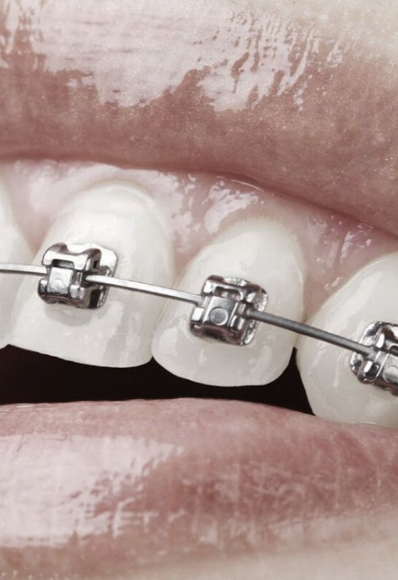 brackets-de-autoligado-baja-friccion-manresa