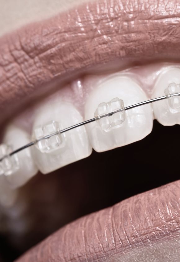 brackets-esteticos-transparentes-manresa