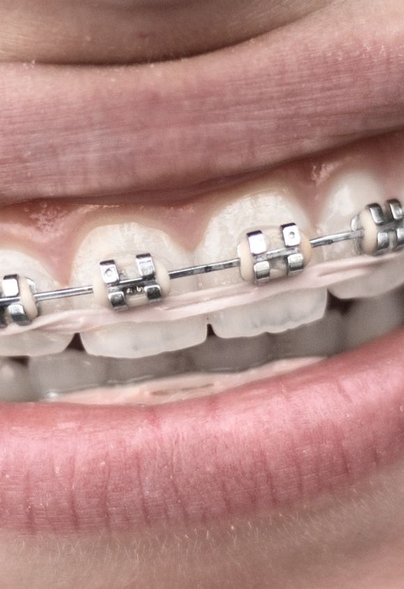 brackets-metalicos-tradicionales-manresa