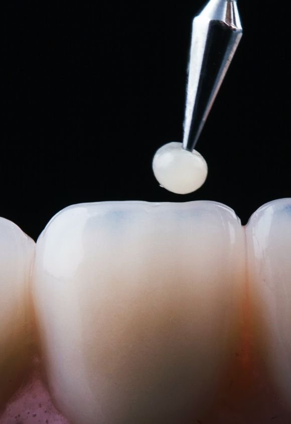 carillas-de-composite-manresa-raga