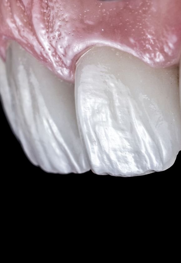 carillas-de-porcelana-manresa-raga