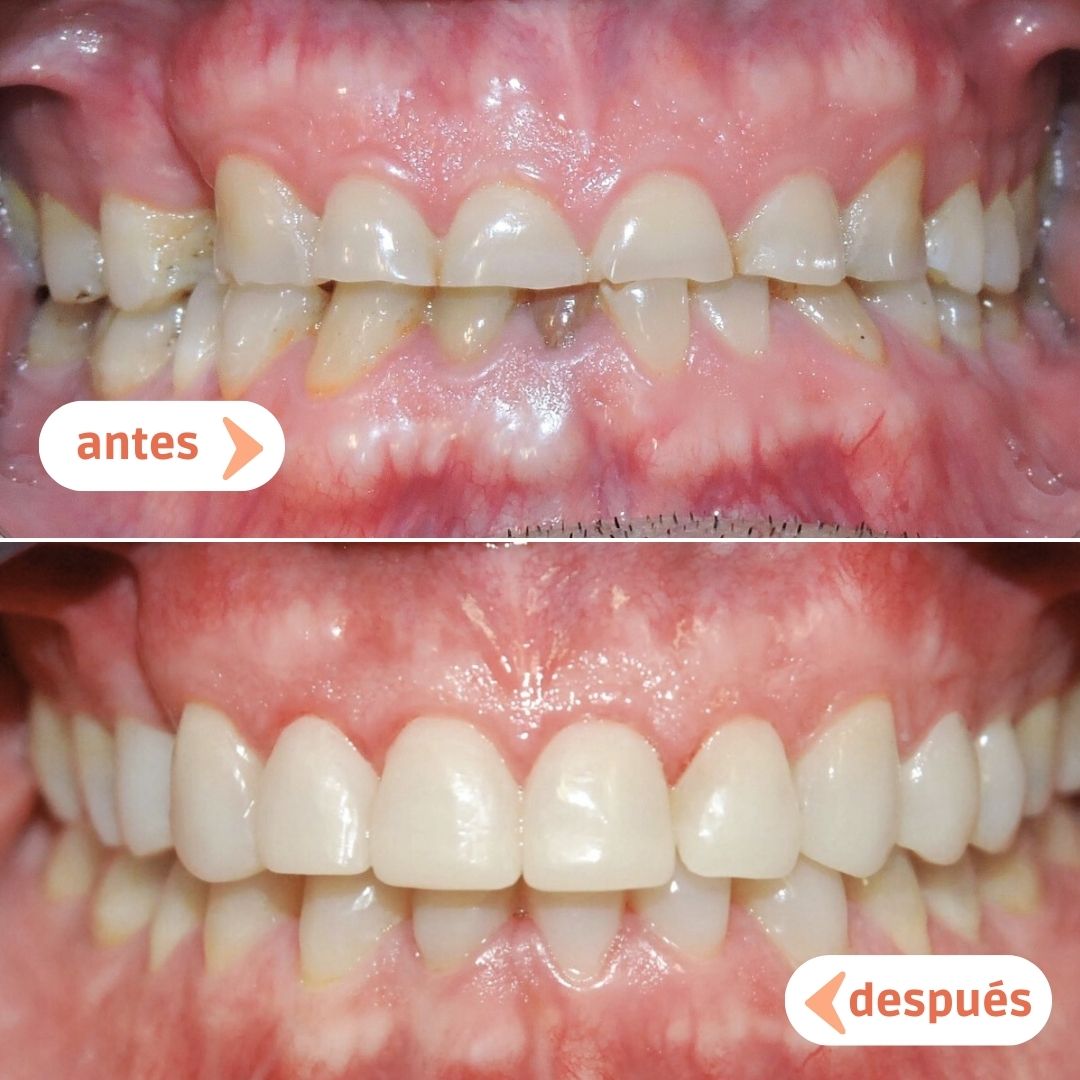 caso-antes-despues-carilla-dientes-cortos-desgastados-manresa