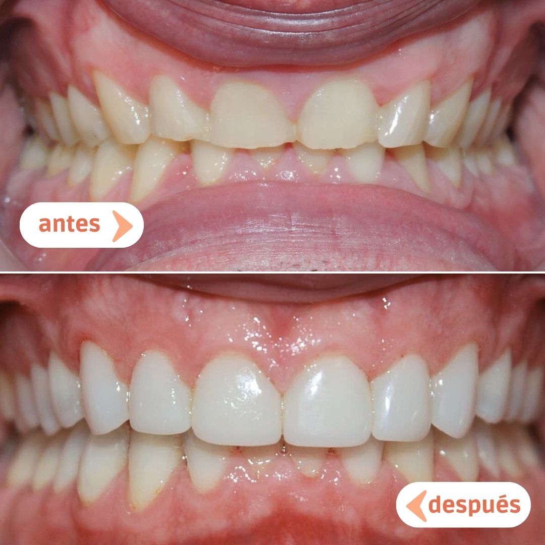 caso-antes-despues-carilla-dientes-cortos-desgastados