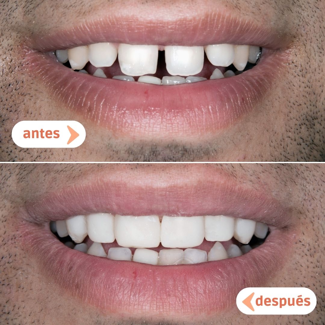 caso-antes-despues-carillas-dentales-dientes-separados-diastemas-manresa