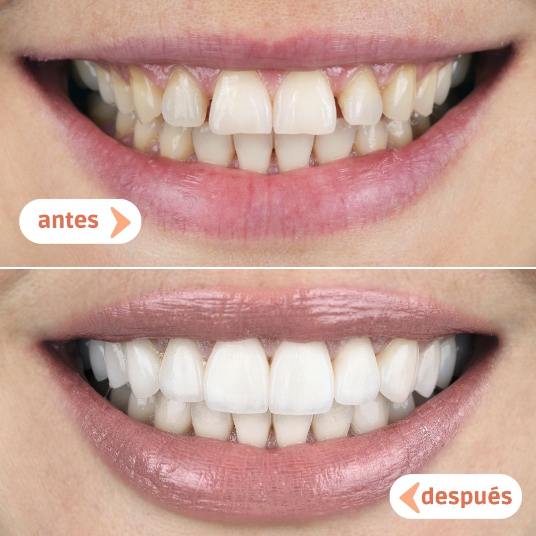 caso-antes-despues-carillas-manresa