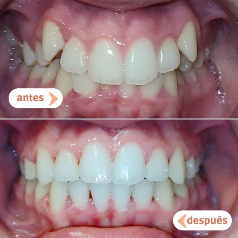 Dientes torcidos antes y después del tratamiento de ortodoncia en Manresa