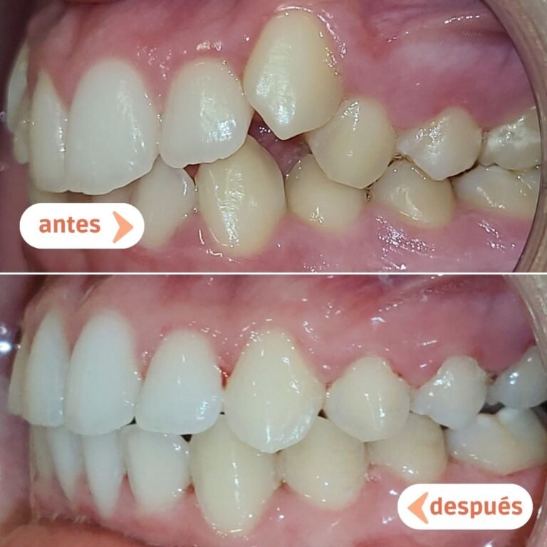 Maloclusión dental y dientes apiñados antes y después del tratamiento con ortodoncia en Raga Manresa