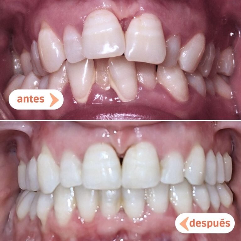 Antes y después del tratamiento de ortodoncia en Manresa: boca con apiñamiento severo