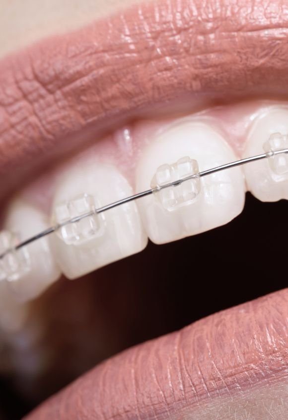 Ortodoncia con brackets en Raga Manresa