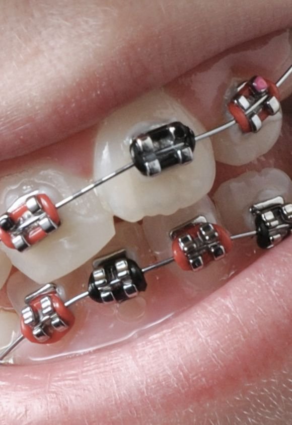 Ortodoncia infantil con brackets o alineadores invisibles Raga Manresa