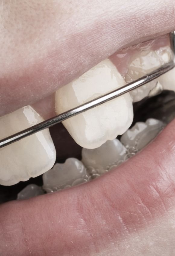 Ortopedia dentofacial infantil en Manresa cl?nica Raga