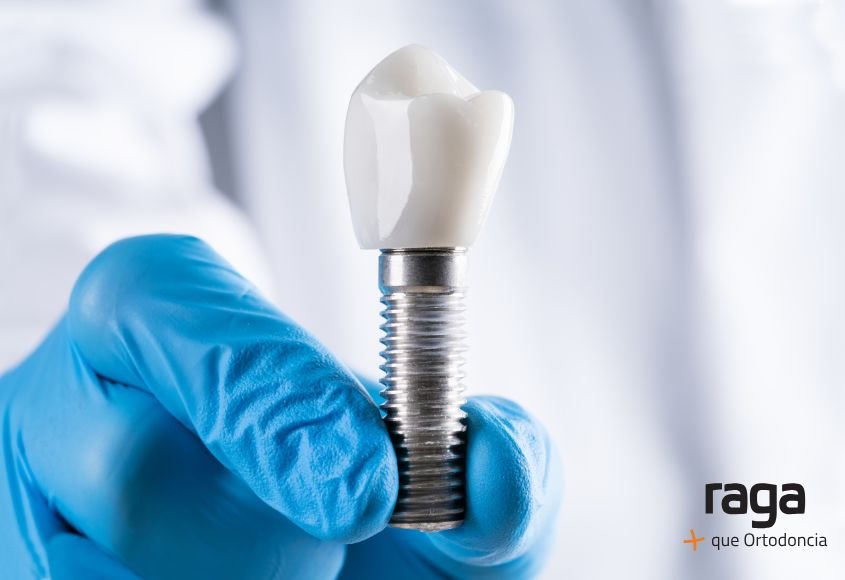 Tipos de implantes dentales