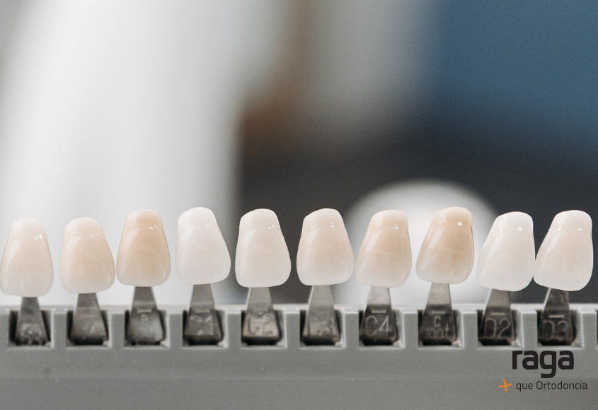 Carillas de composite