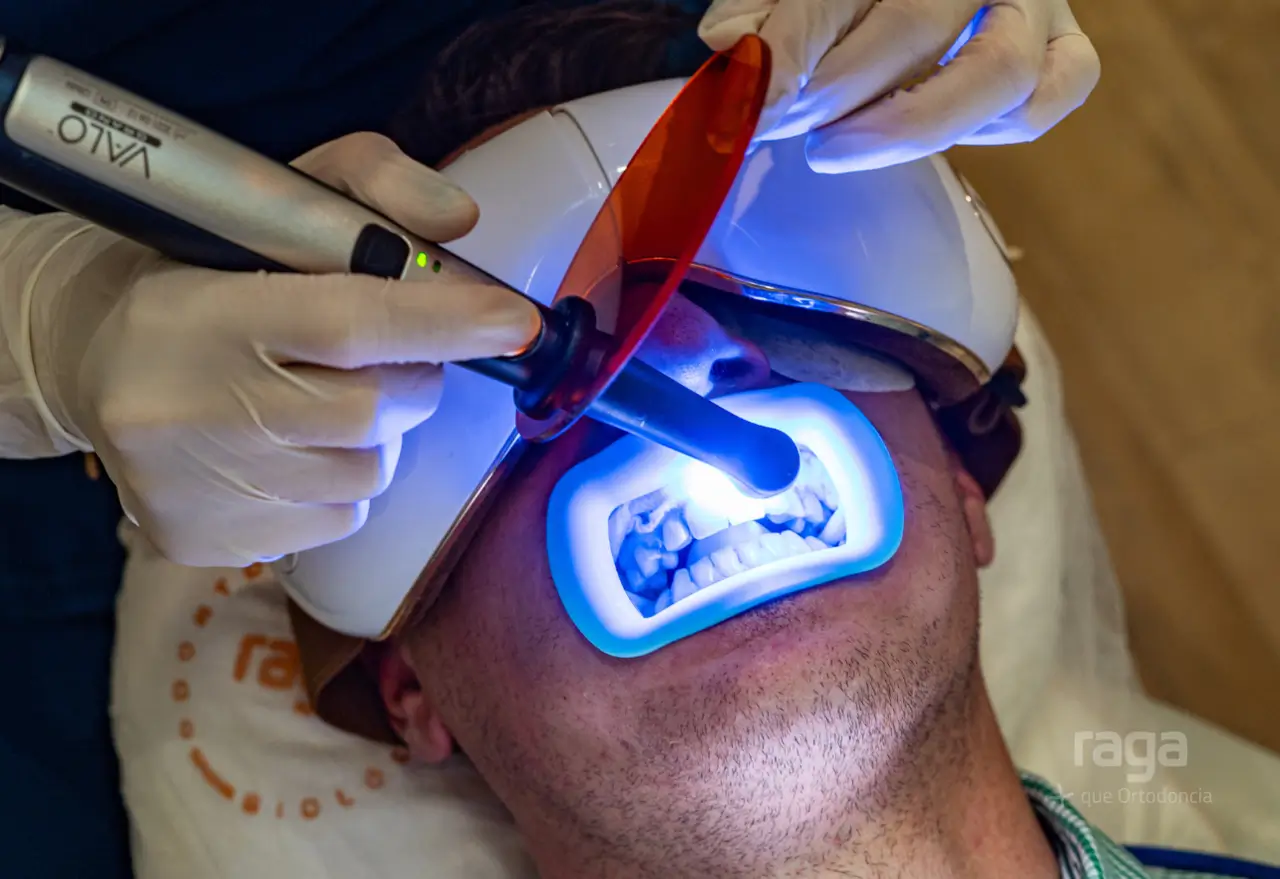 Tratamiento de blanqueamiento dental en paciente para eliminar manchas