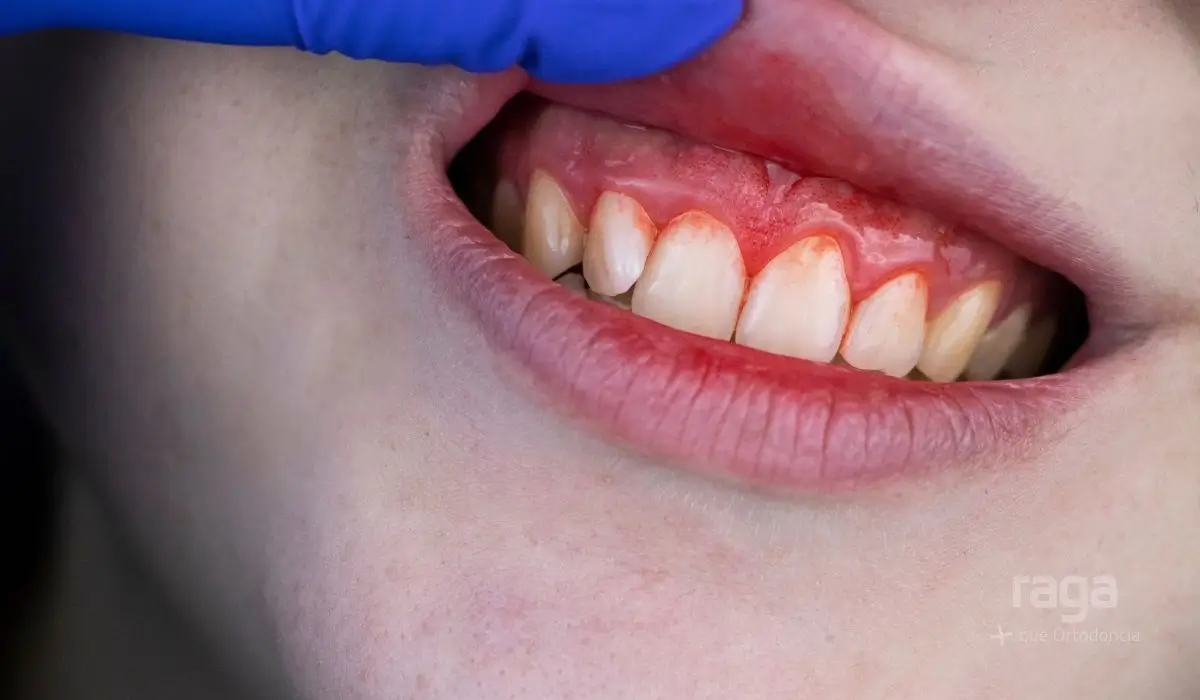 Encías inflamadas y sangrando