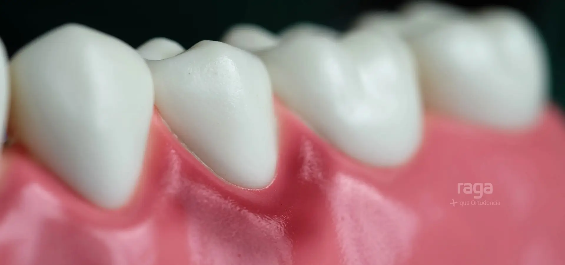 Encías enfermas: diferencias entre gingivitis y periodontitis