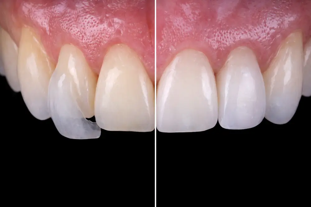 Mitad de una dentadura amarilla sin microcarillas y mitad derecha con microcarillas aplicadas