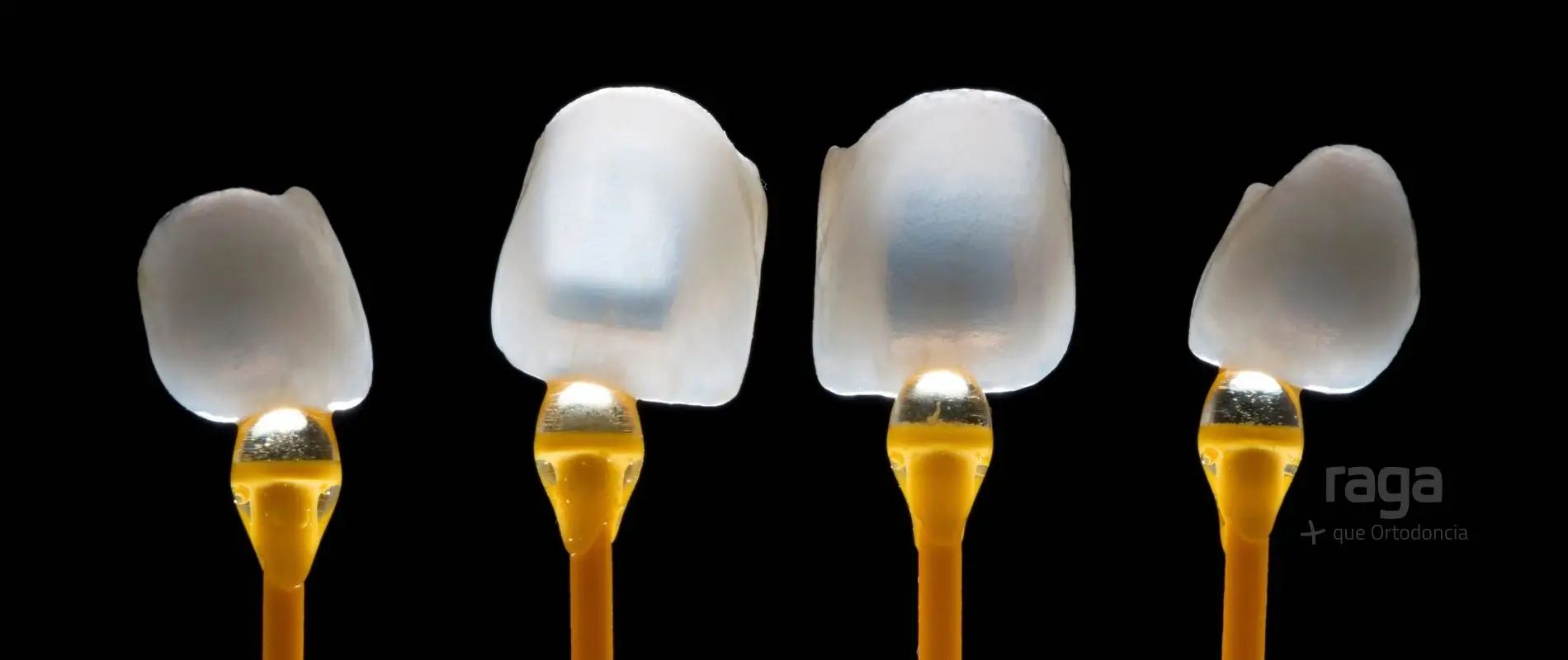 Microcarillas dentales sin tallado en Manresa: tratamiento estética dental