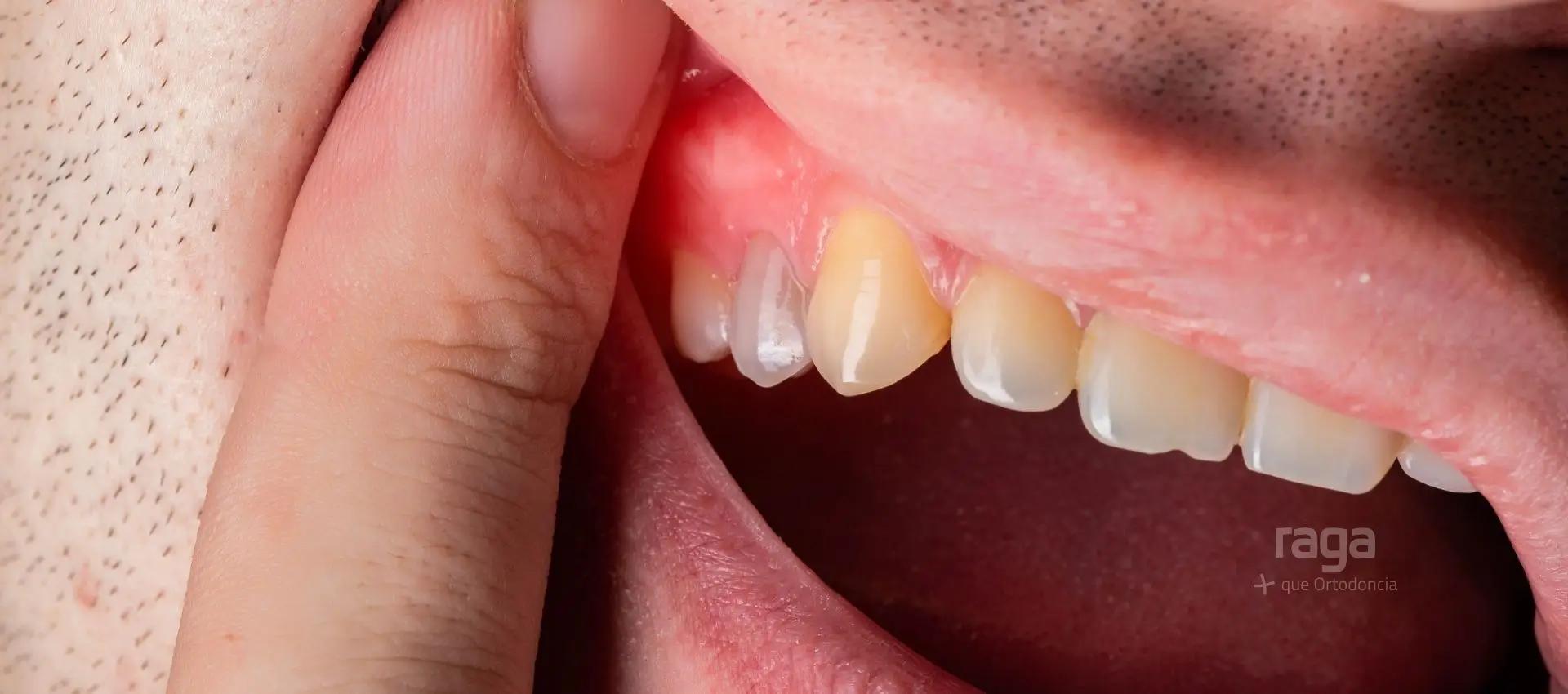 Dudas y mitos sobre el sangrado de encías