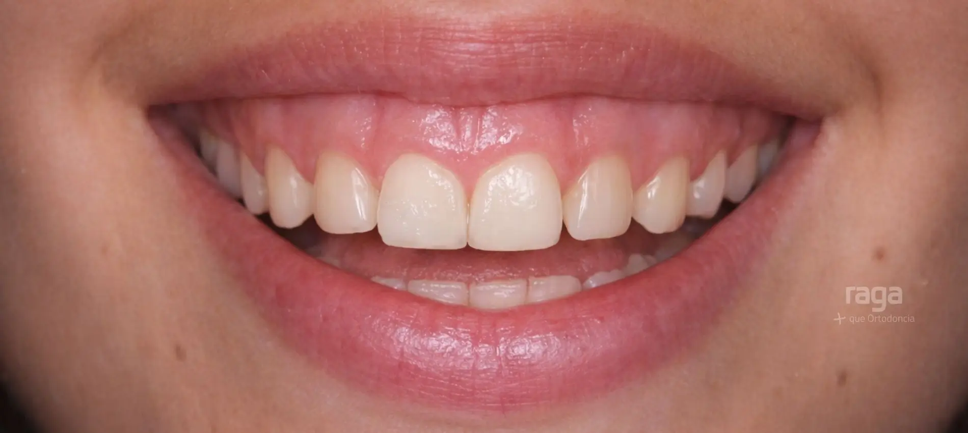 Boca con exceso de encía al sonreír