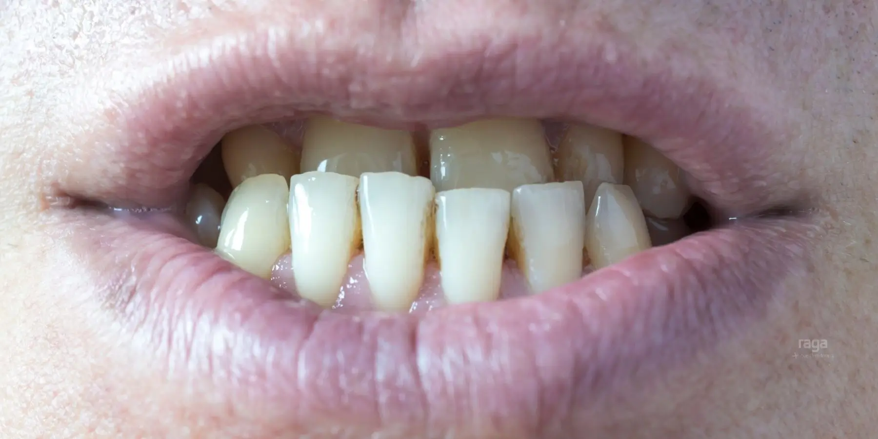 Mandíbula desalineada por mala mordida