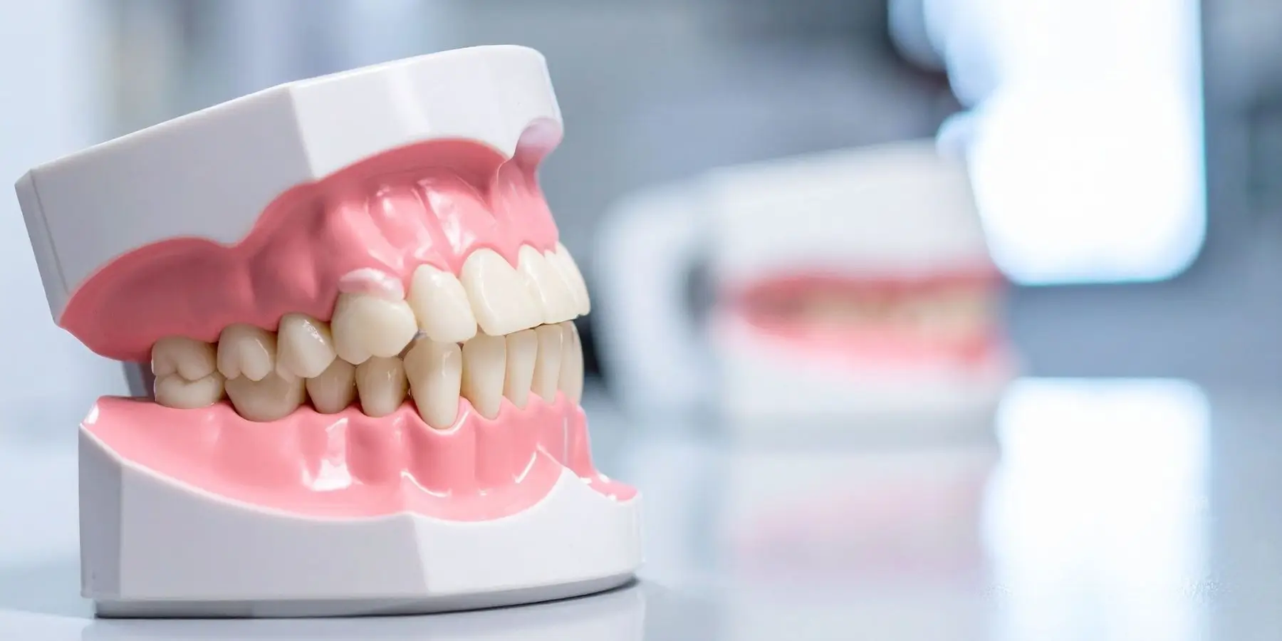 Dientes que no encajan al cerrar la boca