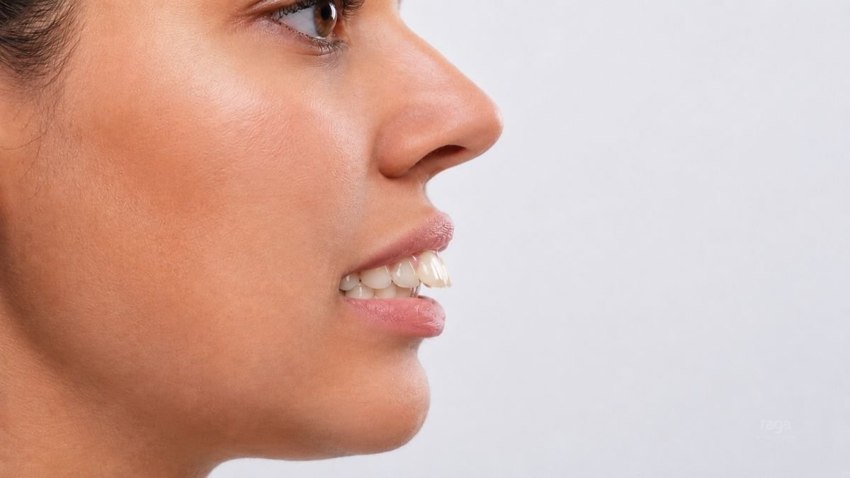 Dientes superiores adelantados que sobresalen