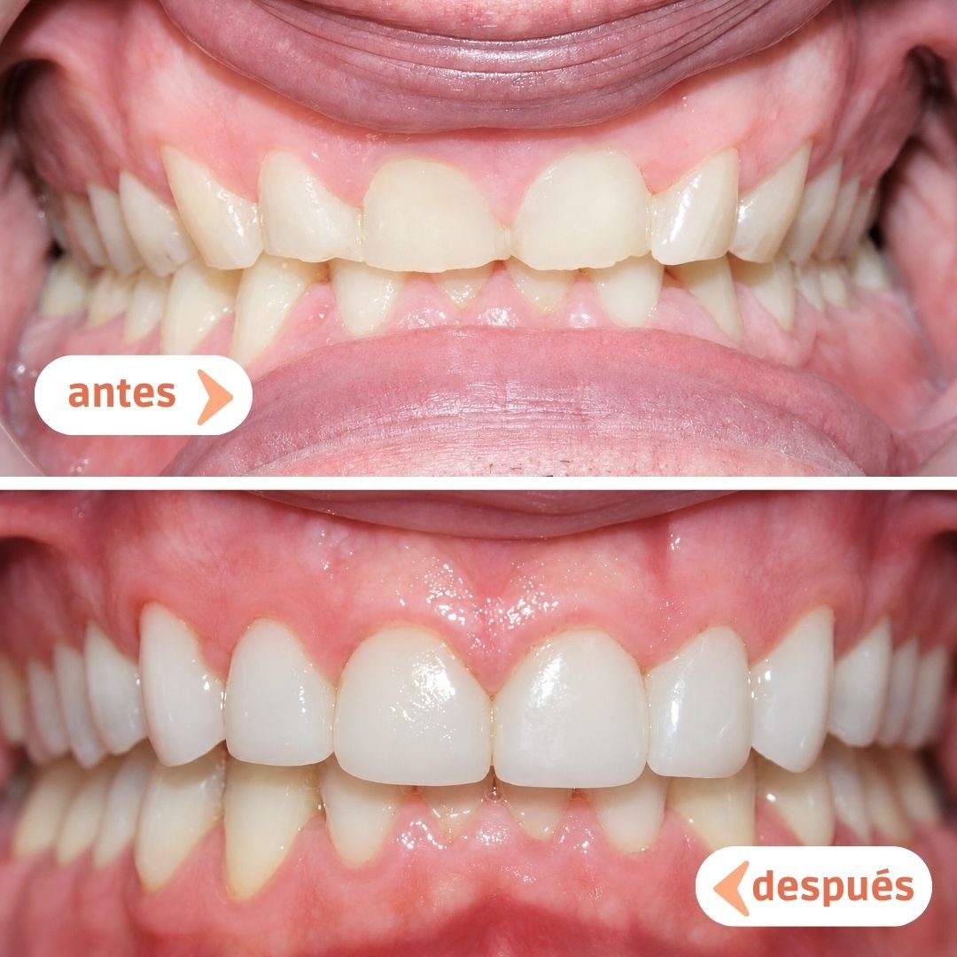 Antes y después de tratamiento de ortodoncia y carillas dentales en Manresa
