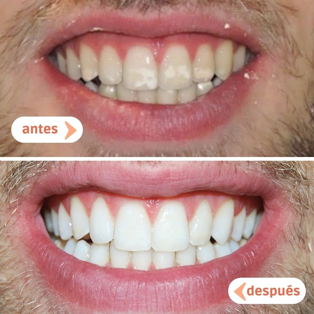 Antes y después de tratamiento de ortodoncia y blanqueamiento dental en Manresa